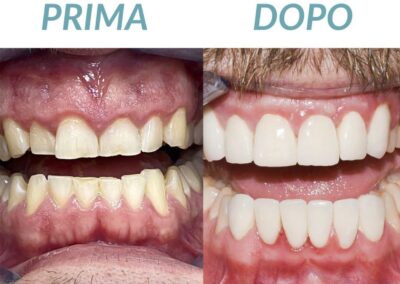 Confronto prima e dopo l'applicazione di faccette e corone in ceramica, mostrando il miglioramento estetico e funzionale realizzato dalla Clinica Dentale Dott. Armando Coppola.